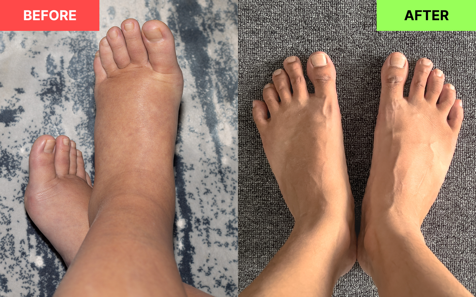 Foot before and after example
